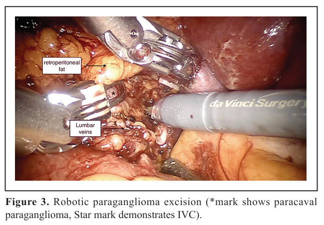 UTJeditor's tweet photo. 🗣️Call for reading and sharing 
Comparative outcomes of laparoscopic vs robotic paraganglioma excision: a tertiary care center experience
URL:   https://t.co/nFyvKLurKh https://t.co/CKnlKIJJ5m