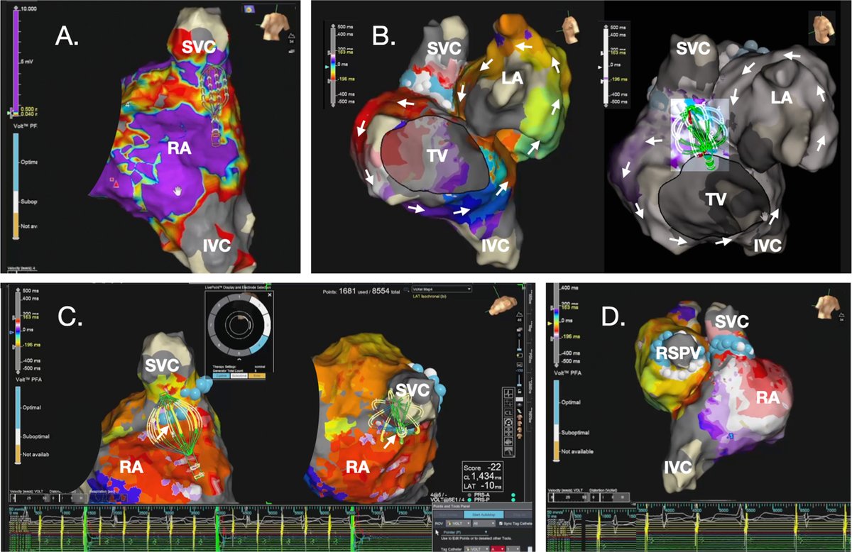 HRS_CaseReports's tweet photo. Selective pulsed field ablation of macroreentrant biatrial tachycardia guided by high-density mapping using a balloon-in-basket catheter 
https://t.co/mAxCLcMUxb https://t.co/eJPDvr6PaV