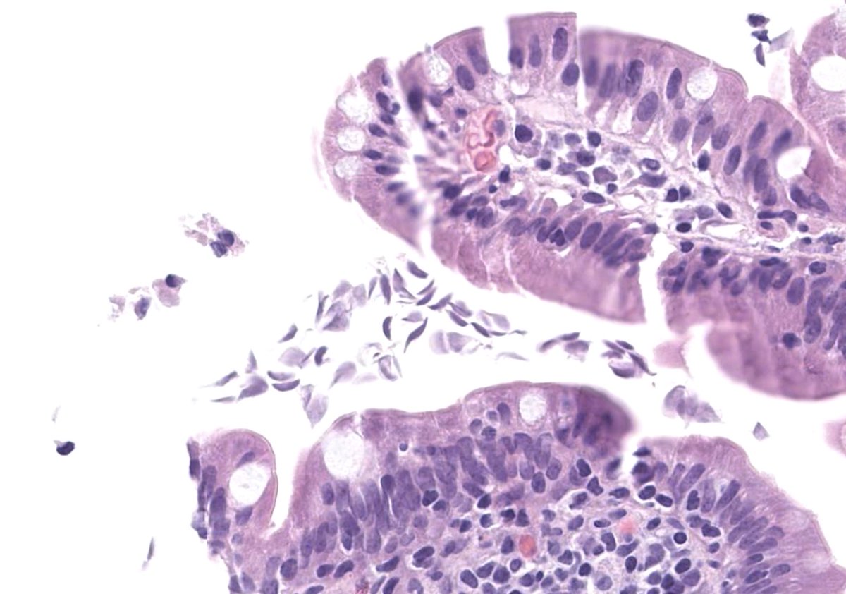 corey_phd's tweet photo. 52 year old man duodenal biopsy https://t.co/DvUbCykc5U