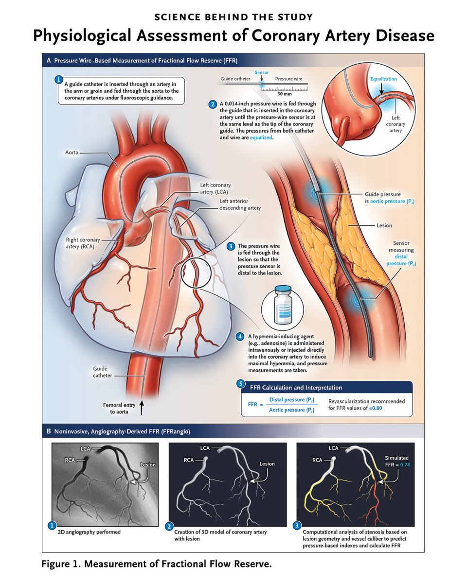 NEJM's tweet photo. Amanda Randles, PhD, describes the scientific foundations of two trials comparing how noninvasive and invasive assessments of fractional flow reserve affect clinical outcomes. 

Learn more about the science behind the study in the editorial “Physiological Assessment of Coronary Artery Disease”: https://t.co/t0qS5itiXq