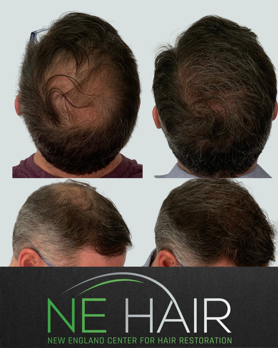 nehair's tweet photo. 3000 grafts. ⚡️
Restoring density isn't about becoming someone else—it's about looking like yourself again.
📞 781-375-2246
📱 WhatsApp: 🇵🇹🇧🇷🇪🇸 508-897-9996
#HairTransplant #MicroFUE #NEHair https://t.co/6ifnx30m0J