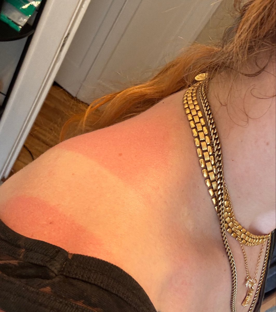 bottleneckloser's tweet photo. That wasn’t very “my family has a history of skin cancer” of me https://t.co/P5wUv6L1XQ
