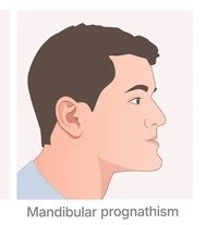 J_C_A__'s tweet photo. Hip dips are normal; around 80% of women have them. You, on the other hand, have an actual facial malformation called mandibular prognathism. https://t.co/zTysX9iPti