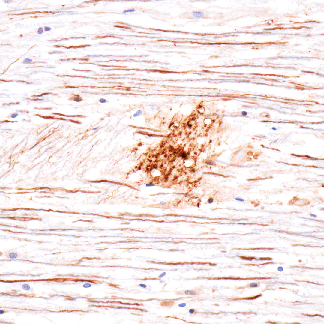 CellSignaling's tweet photo. 【新製品のご紹介】
末梢Tau (Big Tau) は、末梢神経系等で発現する高分子量アイソフォームであり、中枢神経系に存在する低分子量型より疎水性が低く凝集しにくいことが知られています。
#58330 は、ヒトサンプルを用いたWB、IP、IHC-Pに適しています。
https://t.co/zJpAA4Kk6I https://t.co/VhKZMbVU7Y