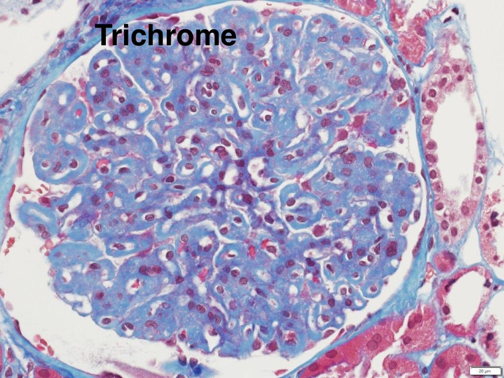 SethiRenalPath's tweet photo. Trichrome and silver stain. 
Silver negative deposits. 
Trichrome is negative as well. https://t.co/n89veiPaNB