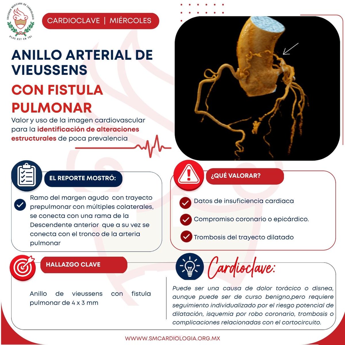 smexcardiologia's tweet photo. 🔑❤️ #Cardioclave
El anillo arterial de Vieussens con fístula pulmonar es una anomalía poco frecuente cuya identificación depende en gran medida de la imagen cardiovascular.
Su reconocimiento oportuno permite evaluar el riesgo de insuficiencia cardiaca, isquemia o trombosis.
#Cardiología #ImagenCardiovascular #SMC #SoySMC
Contenido elaborado por Dra. Liliana Zarco @lilin4l Grupo CT Scanner @cecimatheus Dra Cecilia Matheus
@angel_lievanos8 Dr Jose Angel Lopez Lievanos
@lilin4l Dra Liliana Zarco García