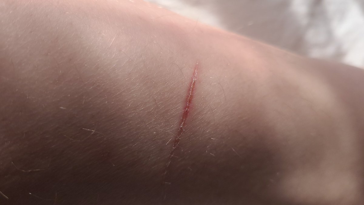 EyeOfMisery's tweet photo. Mainly healed!! (All fake sfx) https://t.co/k9zGb86XUx