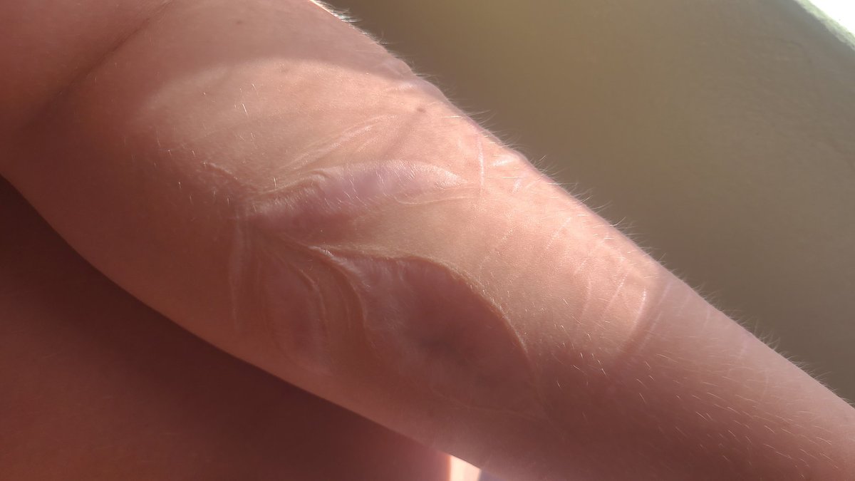 EyeOfMisery's tweet photo. Scars galore and some fatspo (fake body, sfx) #shedtwt https://t.co/2mIoe03ZgO