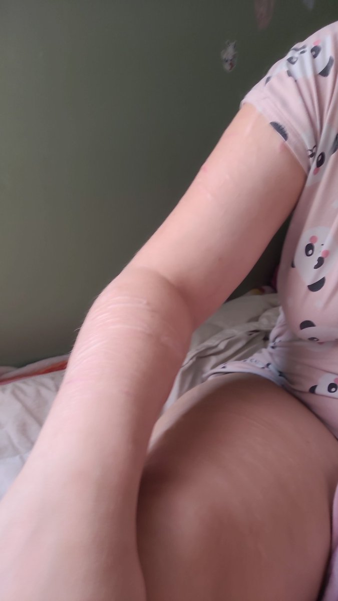 EyeOfMisery's tweet photo. Scars galore and some fatspo (fake body, sfx) #shedtwt https://t.co/2mIoe03ZgO