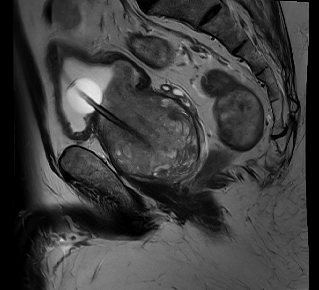 milanhoraplzen's tweet photo. Man 48/y/o, urinary retention, MRI prostate 207mL, @Urology_Plzen decided instead of #HoLEP for robot-assisted simple prostatectomy #RASP, morcelator, 142g. No #EAUguidelines clear recommendation due to missing #RCTs Chapter 5.3.2.f.1 @Uroweb https://t.co/rxH04C8H9J #uroczech https://t.co/GjXtj7DlNU