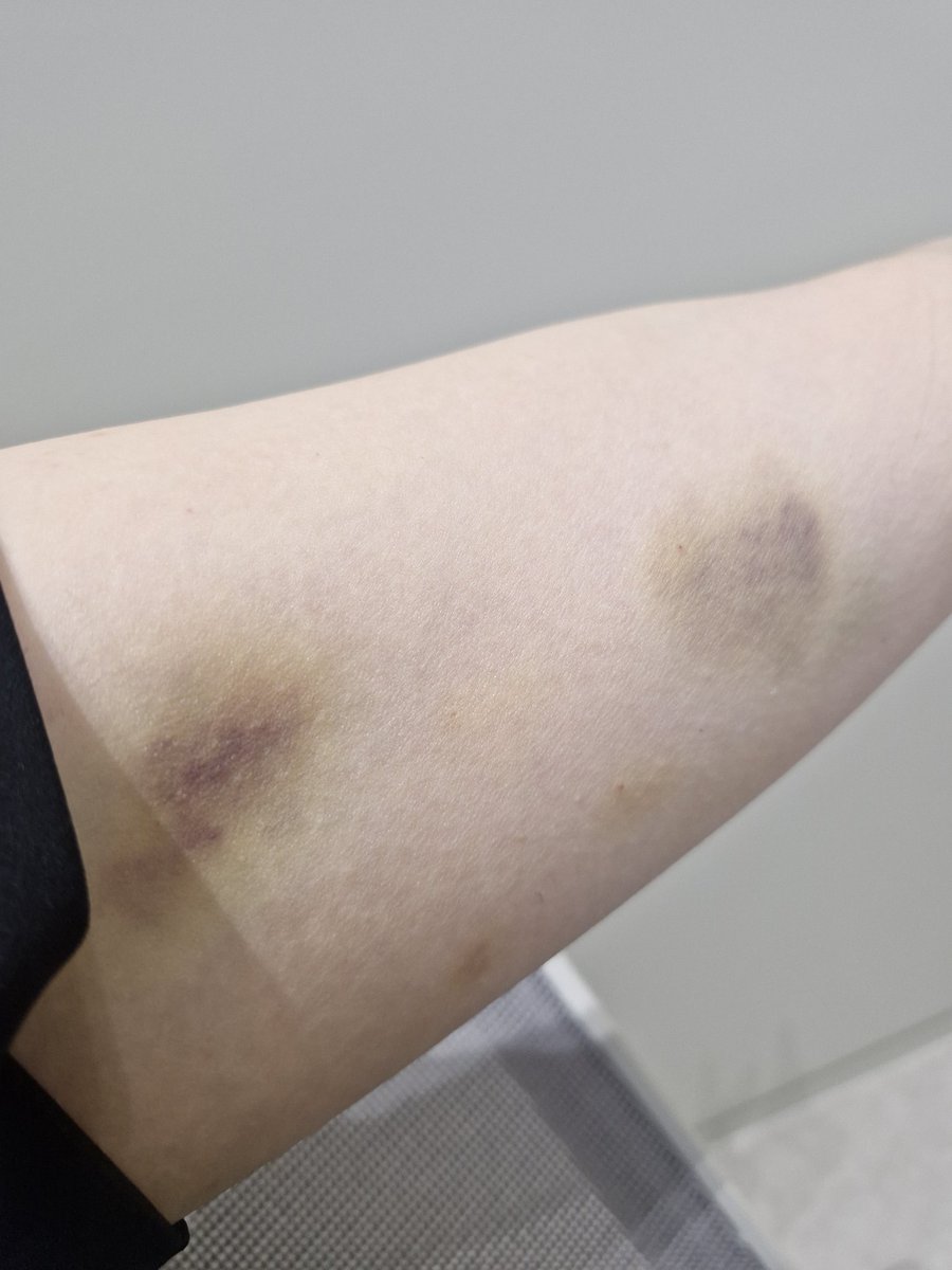 ar319ss's tweet photo. 職場で二の腕に脂肪溶解注射してもらった💉
お腹にもしたけどお腹は意外に痛くない🙆‍♀️
思った以上にあざすごいけど、気にしな～い🪀 https://t.co/OclEv3UStI