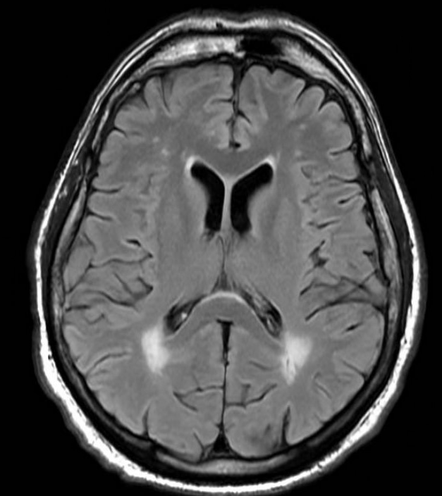 whitfieldlewis6's tweet photo. A 50-year-old male with poorly controlled diabetes. You see these white spots in the Brain. What's your differentials? What's the mechanism?

What other diseases results in these white spots in the white matter? https://t.co/R6tsn7ZW8Q