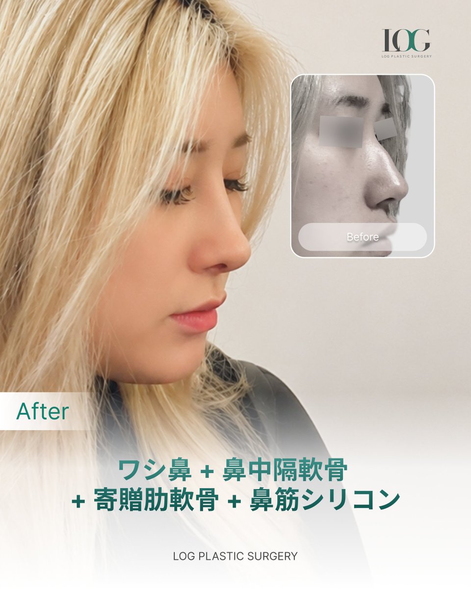 Logps_jp's tweet photo. 鷲鼻、鼻中隔軟骨、寄贈軟骨、鼻筋プロテーゼ

LINE🦌@log-jp

🏥ログ美容外科
新論峴駅(シンノンヒョン) 7番出口から徒歩3分

🕒営業時間
*月〜金曜 10:00~19:00
*土曜 10:00~17:00
*日曜 定休日（毎週日曜）

#韓国整形 #鼻整形 #渡韓整形 https://t.co/gZJB4bCWKJ