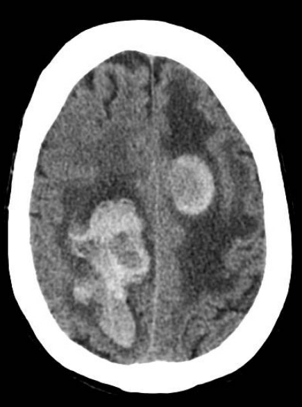 whitfieldlewis6's tweet photo. Top 3 most common causes of hemorrhagic metastatic lesions to the brain include?

How would you treat the edema caused by the tumor?

Drop your thought below
👇👇 https://t.co/B09ASzxPk7