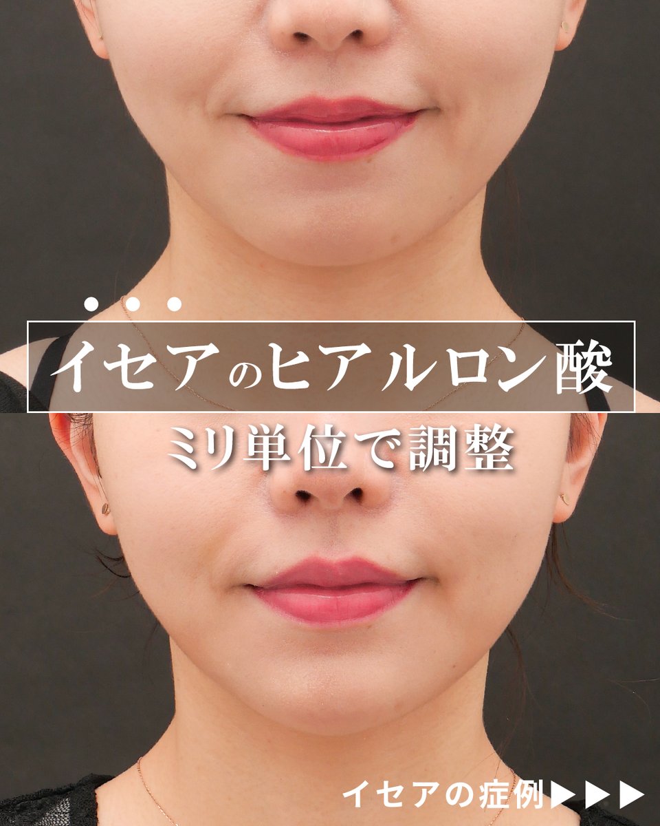 isea_case's tweet photo. 顎ヒアルロン酸　　
執刀医：権東 容秀

Before：術前
After：１週間後

■注入治療Instagram
https://t.co/YmCrDcgRDf

■権東 容秀医師Instagram
https://t.co/uiwabHaYpB

■注入サイト(ヒアルロン酸・ボトックス)
https://t.co/AHtOOB456t

■リスク
アレルギー　動脈塞栓　感染など

■料金
1本　¥77,000(税込)