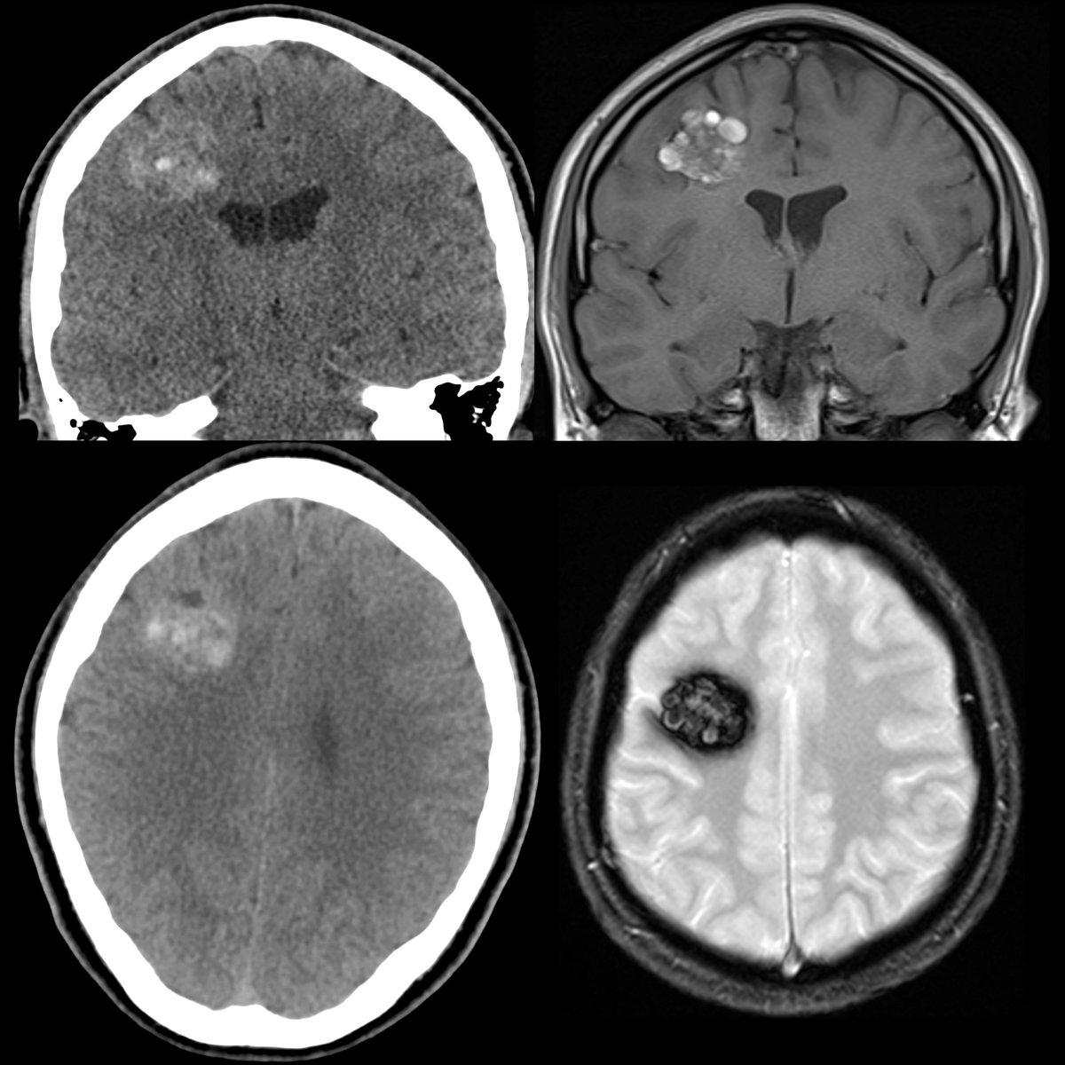 pedsimaging's tweet photo. Teen with headache+tremors
Coronal(above left)+axial (below right) CT without contrast shows slightly hyperdense, round, poorly circumscribed lesion in right frontal lobe
#FOAMed #MedEd #FOAMRad #PedsRad #RadEd #radiology #radiologia #NeuroRad #Neurology #Neurosurgery https://t.co/GulNjrl5fl
