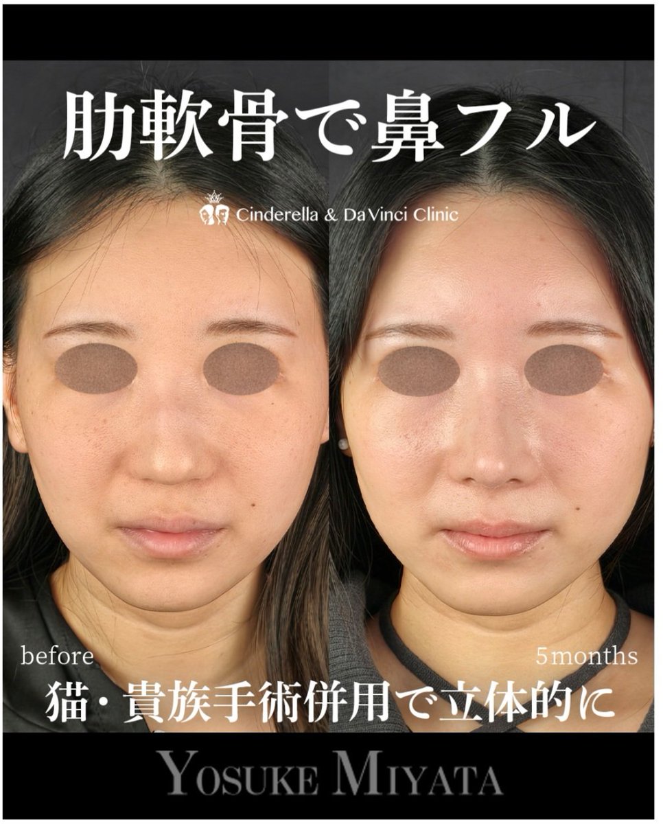 CDC_Miyata's tweet photo. 「鼻の穴を見えなくしたい」
まあまあこれ言われるんですが、鼻の穴は見えてた方がいいです
鼻の穴が見えないということは、相対的に鼻の皮膚の面積が増えるので余計団子鼻に見えたり、鼻が潰れて見えたり長く見えたりします
あまりいいことはありません
鼻の穴は見える見えないの議論じゃないです
見えてた方が良くて、その上で見え方が綺麗かどうかという議論です
個人的な意見です