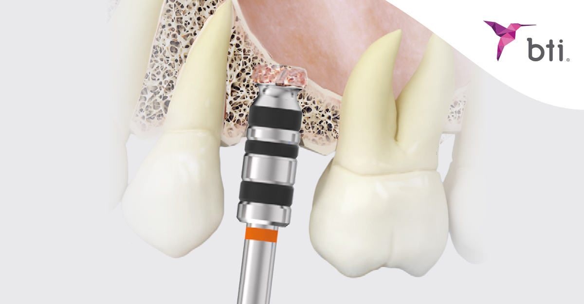 BTIBiotech's tweet photo. Control y seguridad en el fresado.
Las fresas de corte frontal de BTI permiten una instrumentación apical precisa, en elevaciones de seno transalveolares y en el fresado para la colocación de implantes extracortos.
Conoce más en nuestra tienda online 🔗 https://t.co/mgNiijfMaF https://t.co/jnvW8uJwvO