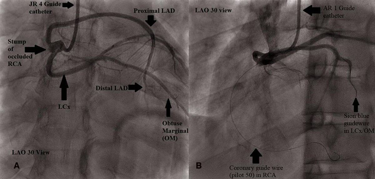 ESC_Journals's tweet photo. Read about this inferior STEMI in a rare coronary anomaly (single coronary artery from RCC) https://t.co/Klgsw4QY4B

#EHJCaseReports @Phiso_de @TJ_Yeo @aayshacader @girishviswa @SukritiBanthiya  @O_Azizy_MD @saramoscatelli7 @EHJCREiC #CardioX #radialfirst https://t.co/MR2m0Ueryl