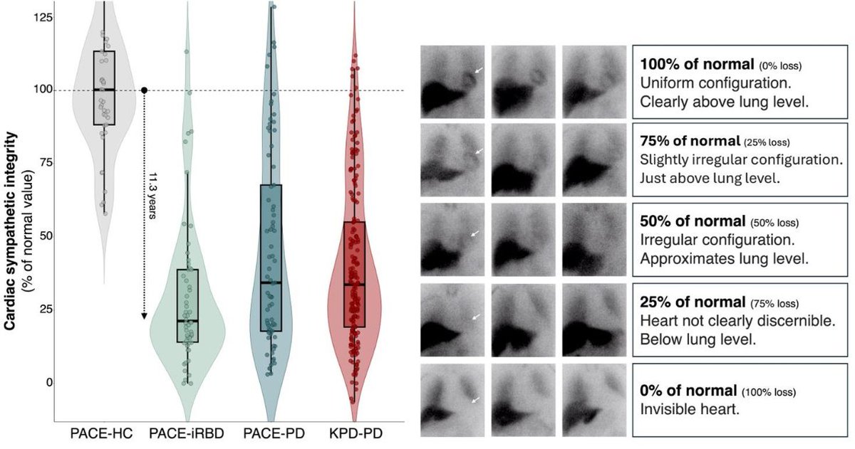 ScienceofPD's tweet photo. Using longitudinal imaging data to model the progression of cardiac sympathetic &amp; nigrostriatal dopaminergic degeneration, @perborghammer &amp; colleagues use the resulting curves to estimate the prodromal period of Body-first Lewy body disease
https://t.co/fI12M29V7m https://t.co/CGGxJYf6jV