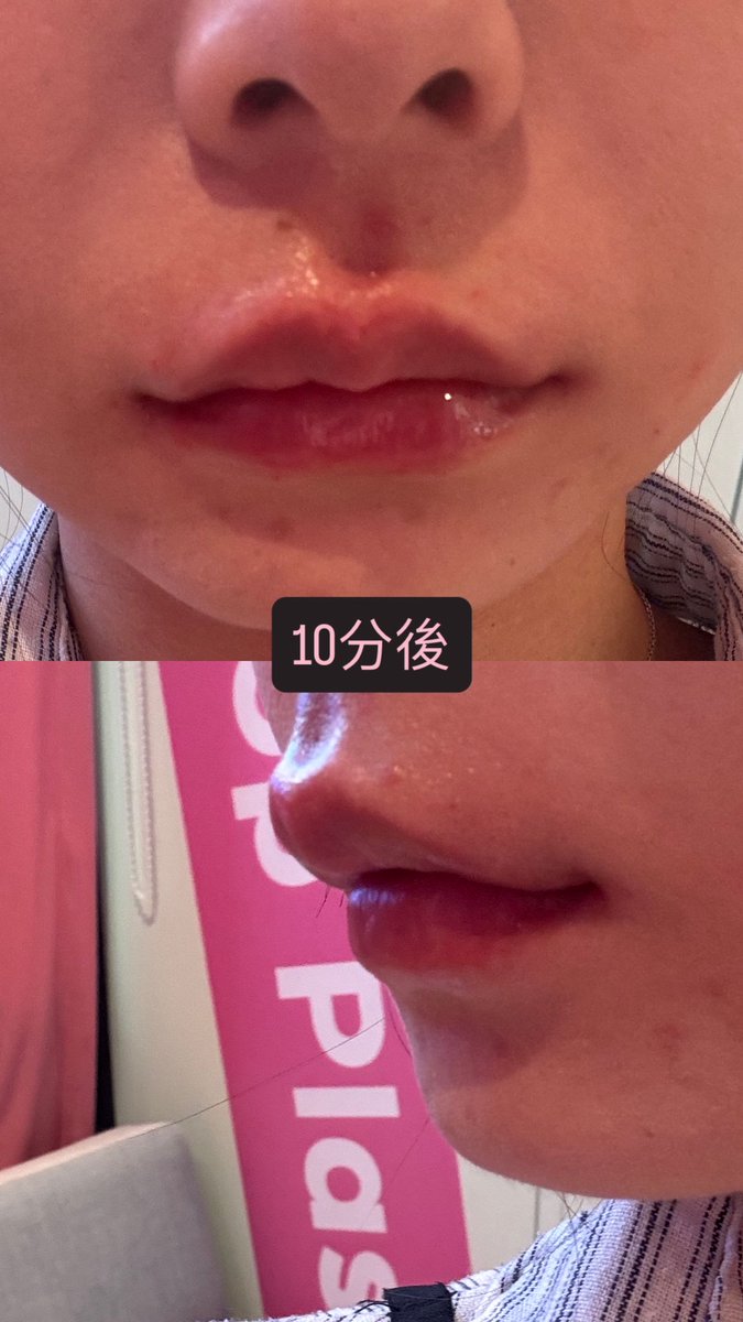 sr7_xm's tweet photo. @lollipopclinic さんではじめてCラインパッケージやった💖
しっかり詳しく教えてくれた
ちゃんと190,000wonぴったりだよ！
なんと言ってもLINE対応が神！
普通に早い、丁寧です

横からも正面からも綺麗な唇になった‼︎

#唇フィラー　#口角フィラー　#人中短縮ボトックス　#口角ボトックス https://t.co/fSYOG0ZezW