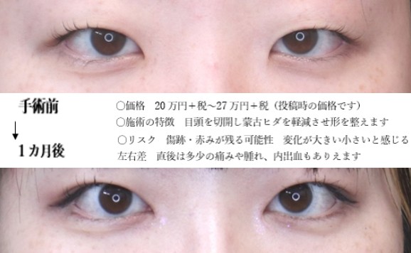 drmatsui's tweet photo. 目の存在感をアップさせる施術。
目頭切開で横の変化を出しつつ、埋没法で縦の変化も生み出しています。
ヒダ感を軽減させることでの印象の変化がわかりやすいです。
もっと変化をさせることも可能ですが、どこまで変えるかは好み次第ですね。
＃目頭切開 https://t.co/2v5OTvUpX6
