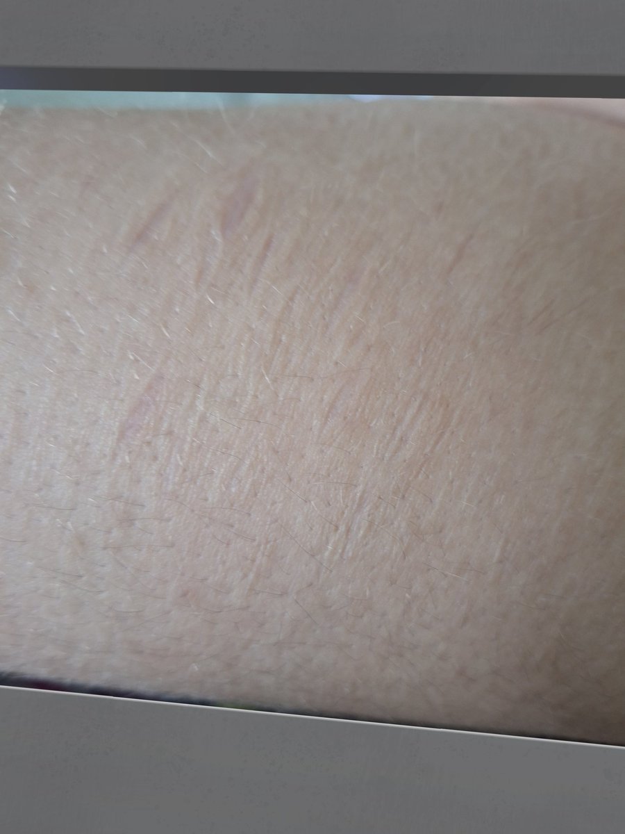 LunaJustFly's tweet photo. 30 days clean

!!ALL HEALED!!
#slittwt https://t.co/T31DddMAHg