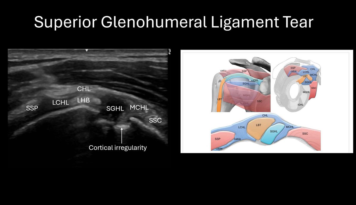 MillwardLuke's tweet photo. SGHL tear, cortical irregularity of the humeral head and intraarticular synovial proliferative changes within the joint space. Furthermore, there was a full thickness tear of supraspinatus and a large anechoic effusion within the bursal plane. Beautifully seen with ultrasound https://t.co/hT8MSm05lw