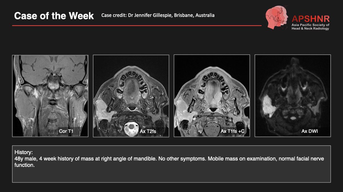 APSHNRORG's tweet photo. APSHNR Case of the Week is here!

Share your thought, and join the discussion.

The answer &amp; teaching points will be revealed this Saturday.
After 2 weeks, the case moves to the members-only APSHNR Case Archive at https://t.co/rDDuXP82Vo

#APSHNR #CaseOfTheWeek #HeadNeckRadiology https://t.co/onZOoP1vrZ