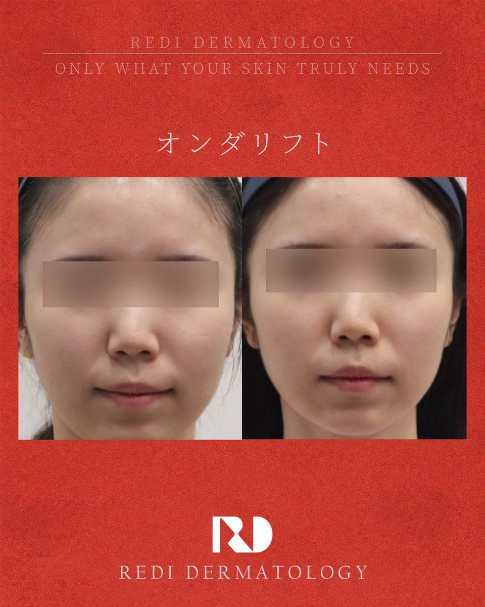 rediderma's tweet photo. 抽選で3名様に、オンダリフト施術を
無料でプレゼント。

韓国のレディ皮膚科が
特別なキャンペーンをご用意しました。

【参加方法】
・アカウントをフォロー
・投稿に「いいね」
・投稿をリポスト

【施術内容】
・オンダリフト（ボディまたはフェイス）

【応募期間】
・6月24日 ～ 7月23日

レディ皮膚科で、
本物のリフトアップ施術をぜひご体験ください。

※本キャンペーンは、参加者数が50名未満の場合、予告なく中止となる場合がございます。

#オンダリフト #オンダ #たるみ #引き上げ #老化 #無料当選 #韓国皮膚科 #韓国美容皮膚科 #タイトニング #ウルセラ #ウルセラピープライム #アンチエイジング #韓国クリニック #美容クリニック #韓国美容 #美肌 #ジュベルック #ジュベルックスキン #ツヤ #リトゥオ #デンシティ #オールタイト #ポテンツァ
#ウルトラクリア #ミラゼット