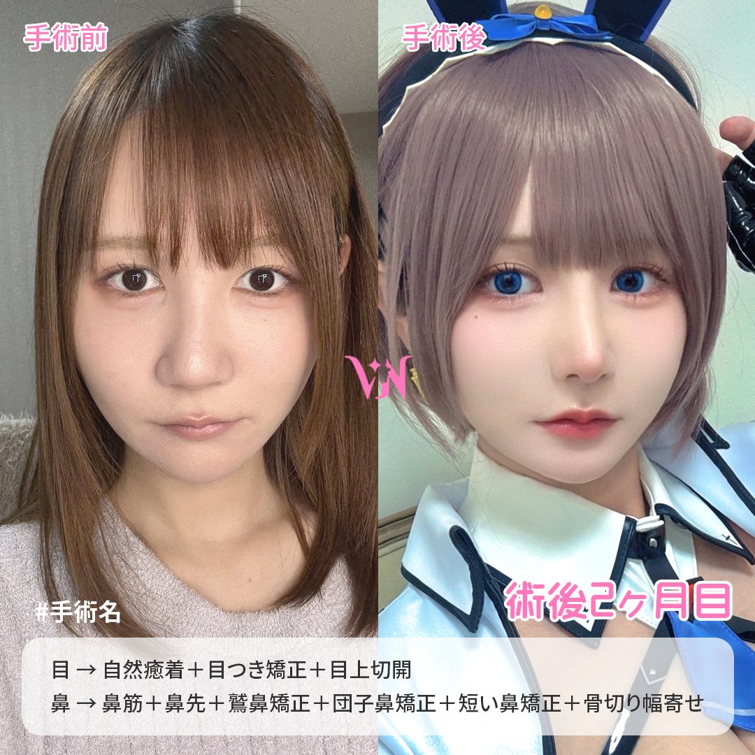 vannypsjp's tweet photo. 💖バンニ美容外科　症例写真💖

🔸手術内容🔸
【目】 自然癒着＋目つき矯正＋目上切開
【鼻】 鼻筋(鼻中隔軟骨)＋鼻先(鼻中隔軟骨)＋鷲鼻矯正＋団子鼻矯正＋短い鼻矯正＋骨切り幅寄せ

『眠たそうな目元から、ぱっちりとした華やかな目元へ。鼻筋・鼻先・鼻幅までトータルで整え、横顔も正面も美しい仕上がりに。』

〈自然癒着〉 → 左右差のある二重を改善し、自然でバランスの良い二重ラインを作る手術
〈目つき矯正〉 → 目を開く力を改善し、眠たそうに見える目元をはっきりとした印象にする手術
〈目上切開〉 → 目頭切開に近い効果がありますが、目頭を必要以上に寄せず、自然に横幅を広げたい方に適した手術です。また、二重の始まり（蒙古ひだ側）の幅を広げたい場合にも効果的な手術

〈鼻筋〉 → すっきりとした立体感のあるラインを作る手術
〈鼻先〉 → 鼻先に高さを出し、よりシャープで自然な鼻先に整える手術
〈鷲鼻矯正〉 → 鼻筋の出っ張りや凸凹を改善し、なめらかなラインに整える手術
〈団子鼻矯正〉 → 丸みのある鼻先をすっきりと細く見せる手術
〈短い鼻矯正〉 → 鼻先を少し下げて鼻の長さを整え、正面から鼻の穴が見えにくい自然な形にする手術
〈骨切り幅寄せ〉 → 広く太く見える鼻筋を細く整え、すっきりとした鼻筋にする手術

お問い合わせや施術予約は公式LINEまで💌
https://t.co/4O2j3YLgFq 

ホームページ 
https://t.co/g33AhhBrw4

#韓国整形 #二重整形 #二重再手術 #自然癒着 #二重切開 #目つき矯正 #眼瞼下垂 #目上切開 #目頭切開 #目尻切開 #タレ目切開 #目下切開 #額挙上 #鼻整形 #鼻再手術 #鼻筋 #鼻先 #団子鼻矯正 #鷲鼻矯正 #低い鼻矯正 #長い鼻矯正 #短い鼻矯正 #鼻唇角矯正 #小鼻縮小 #機能鼻手術 #下鼻甲介 #鼻中隔湾曲症 #クリニック