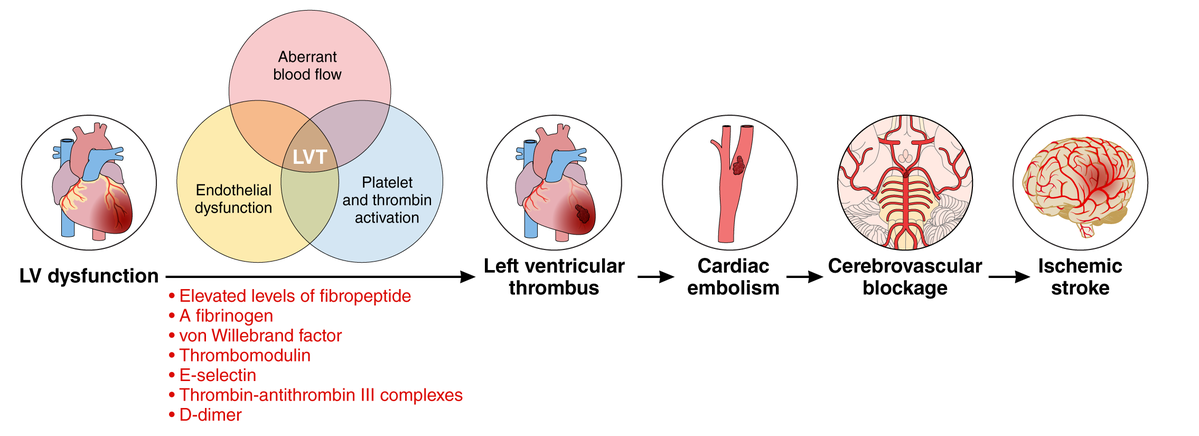 AHAScience's tweet photo. Published today, Management of Patients at Risk of Ischemic Stroke With Left Ventricular Systolic Dysfunction in the Absence of Intracardiac Thrombus: A Scientific Statement from the American Heart Association. https://t.co/Jgu23h0BQV

✍🏼  @RichaSharmaMD @JimSiegler @LiverpoolCCS @JennaSkowronski

📷 Mechanisms of stroke with left ventricular systolic dysfunction