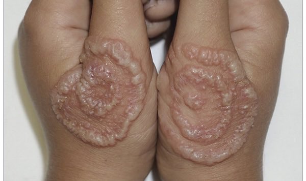 DrMedica_13's tweet photo. ❓ What is the diagnosis?

A. Pompholyx (Dyshidrotic eczema)
B. Bullous Tinea Manuum
C. Bullous Impetigo
D. Contact Dermatitis

💡 Hint: A dermatophyte infection affecting one hand. https://t.co/Yx5025dWOI
