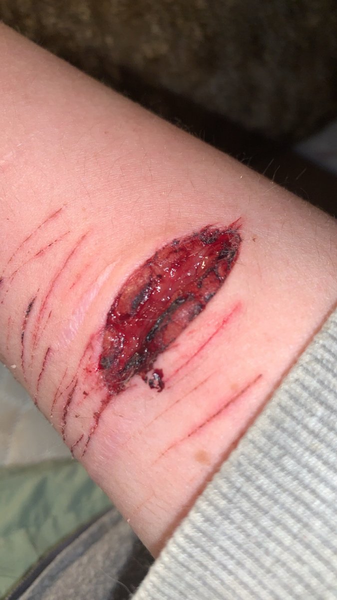 v1olent_d0g's tweet photo. parents saw this one n are makin me get stitches :’p
anyway hit two veins and i think severed one completely https://t.co/5pcmq4wbmk
