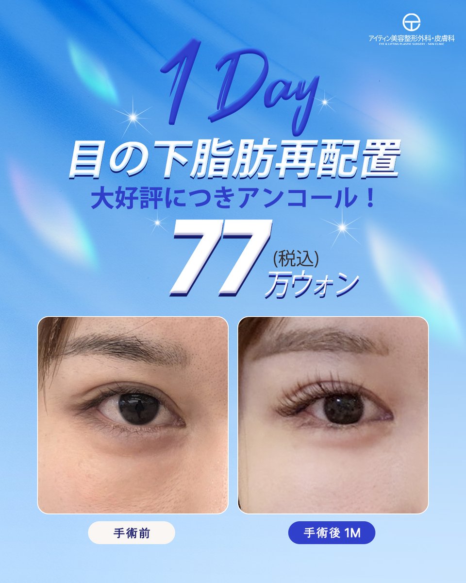 eyetingjp's tweet photo. 「疲れてる？」
実はそれ、クマではなく
目の下の脂肪かもしれません。
大好評につきアンコール✨
目の下脂肪再配置
税込77万ウォン

掲載写真は術後1ヶ月。
自然なのにここまで印象が変わります👀

#クマ取り #目の下脂肪再配置 #韓国整形 #美容整形 https://t.co/EpW15hIole