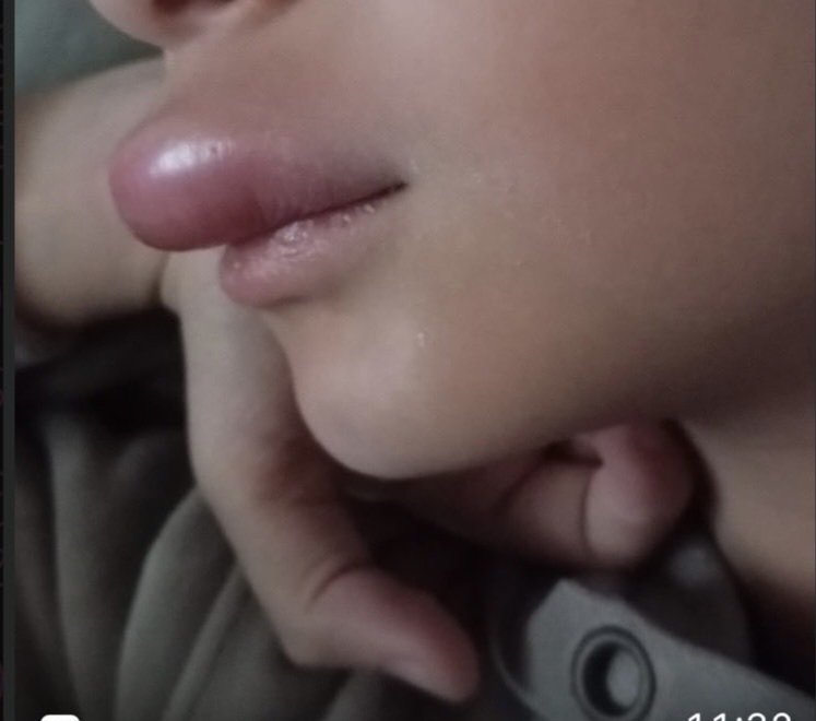 vgwjt's tweet photo. 🚨 فتاة تستيقظ لتجد شفتيها بهذا الشكل الصادم.. 😳
برأيكم.. ما السبب الحقيقي وراء هذا التورم؟ https://t.co/WQbrJGCTWa