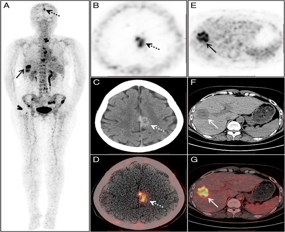 ClinNuclearMed's tweet photo. Current Issue: 68Ga-DOTA-IBA Uptake in Meningioma and Liver Metastasis of Breast Cancer https://t.co/u0lClZRGZc https://t.co/2v6VAmxKEw