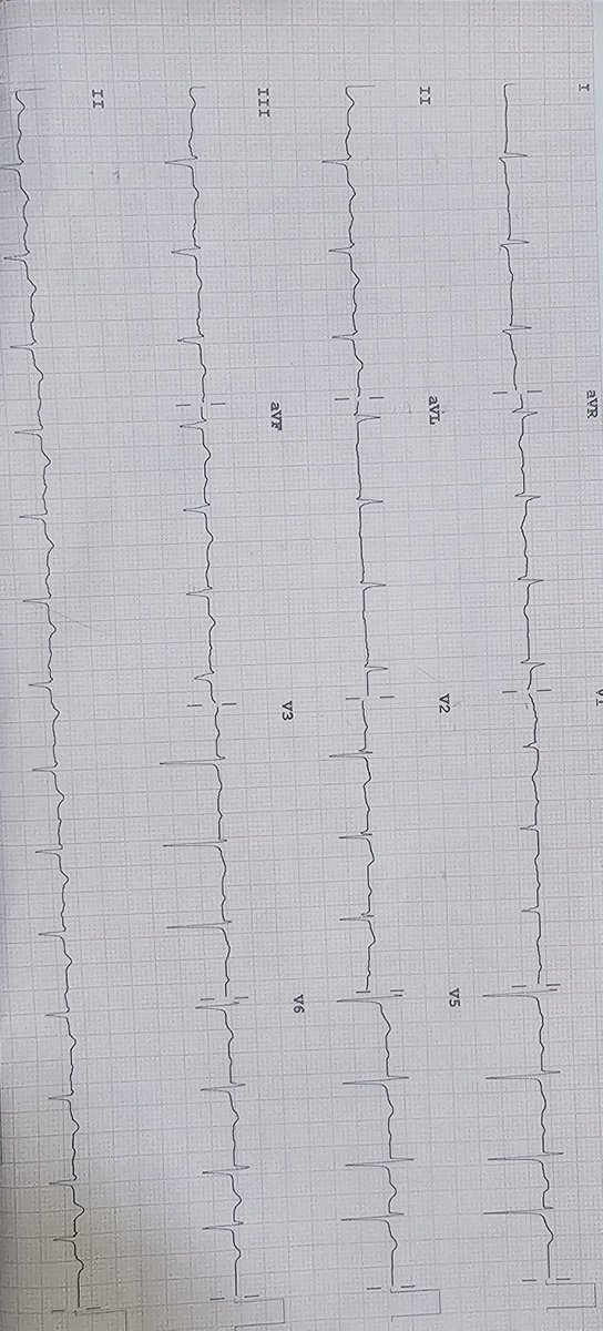 a4aaron1's tweet photo. 80 year old male with no known comorbs h/o LOC at home 
ECG is shown below 
Pls opine 

 @Ecgloverr @ecgandrhythmRoe @Frances98392343 @docakx @ECGQuizzes #cardio #MedX https://t.co/Ic0uAj1dNm