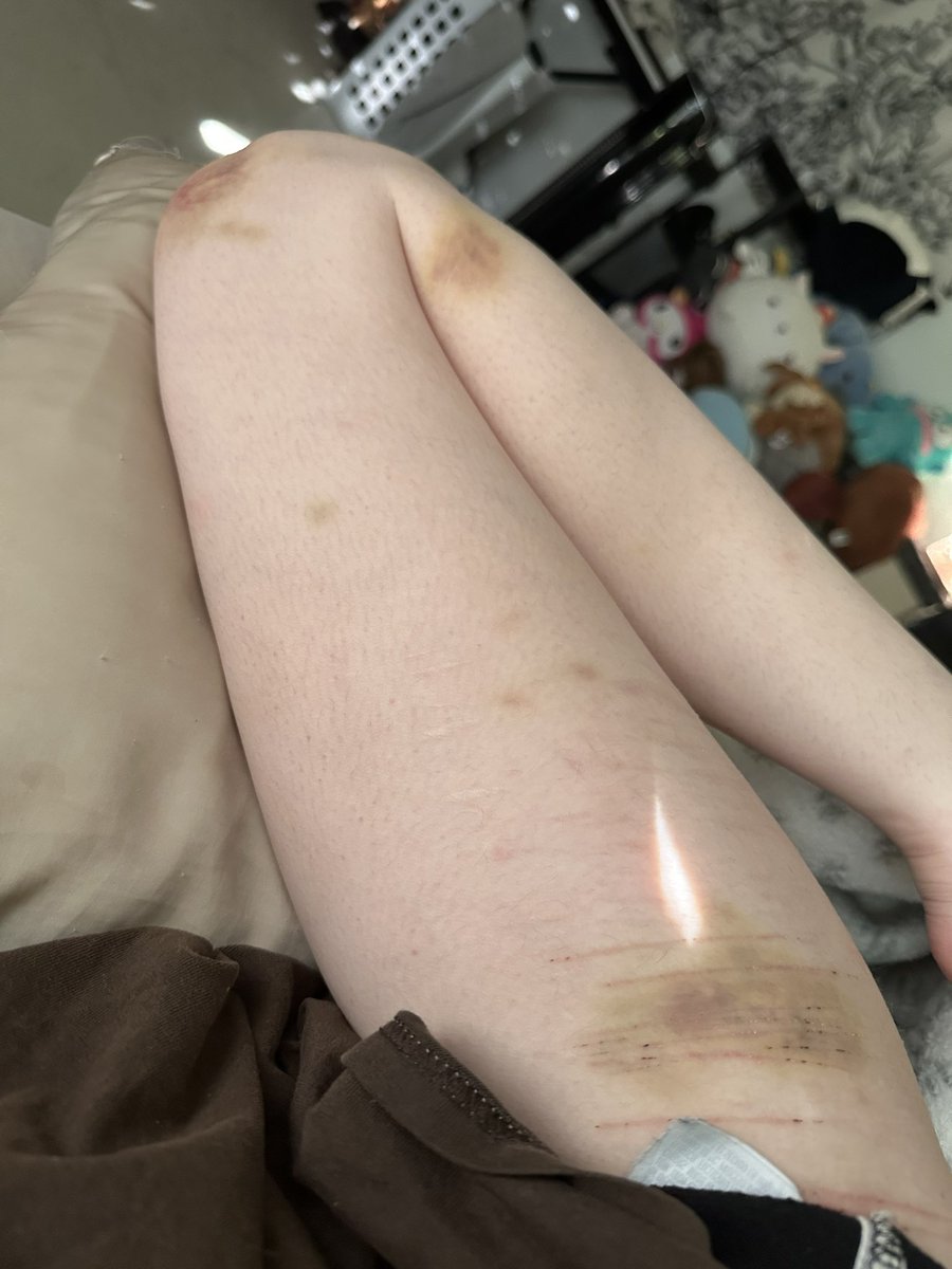 montiemoz's tweet photo. i know i talk about my mysterious bruises all the time but. https://t.co/4XYDcEvDAj