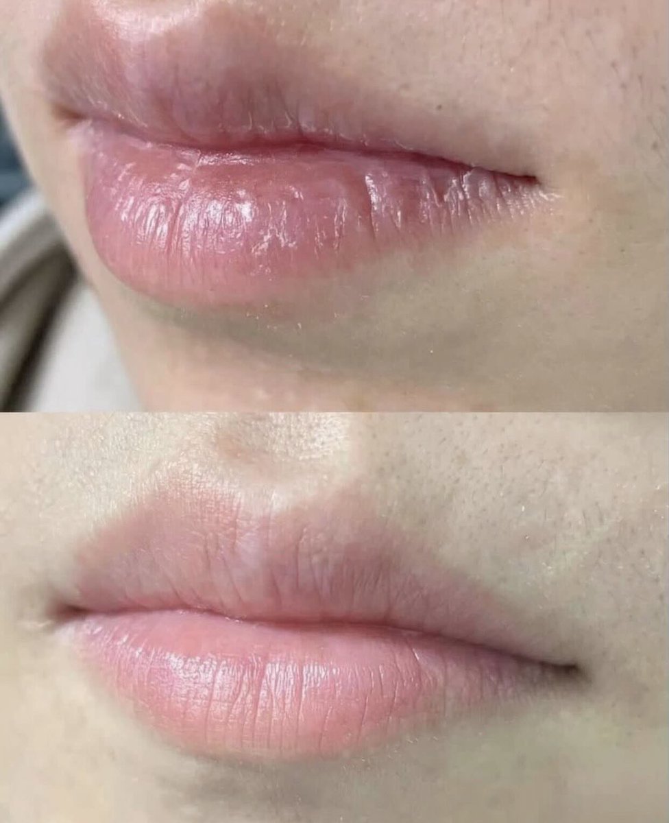 venggk's tweet photo. Aku rutin pake ini tiap malem ya.. jd ini tuh exfo bibir gtu d aku ngaruh bgt 2 bulan jd pink https://t.co/afewtsIdZL