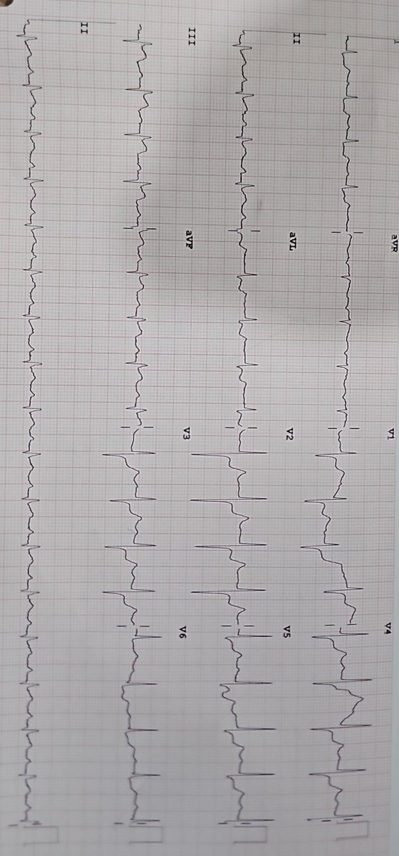 a4aaron1's tweet photo. 50 year old female patient, known diabetic for 7 years, presented with c/o diziness and 2 episodes of vomiting 
Suspected vessel involved
Along with loading, do we give fluids also?
@Ecgloverr @ecgandrhythmRoe @Frances98392343 @docakx @ECGQuizzes #cardio #MedX https://t.co/z2aim1fRxH