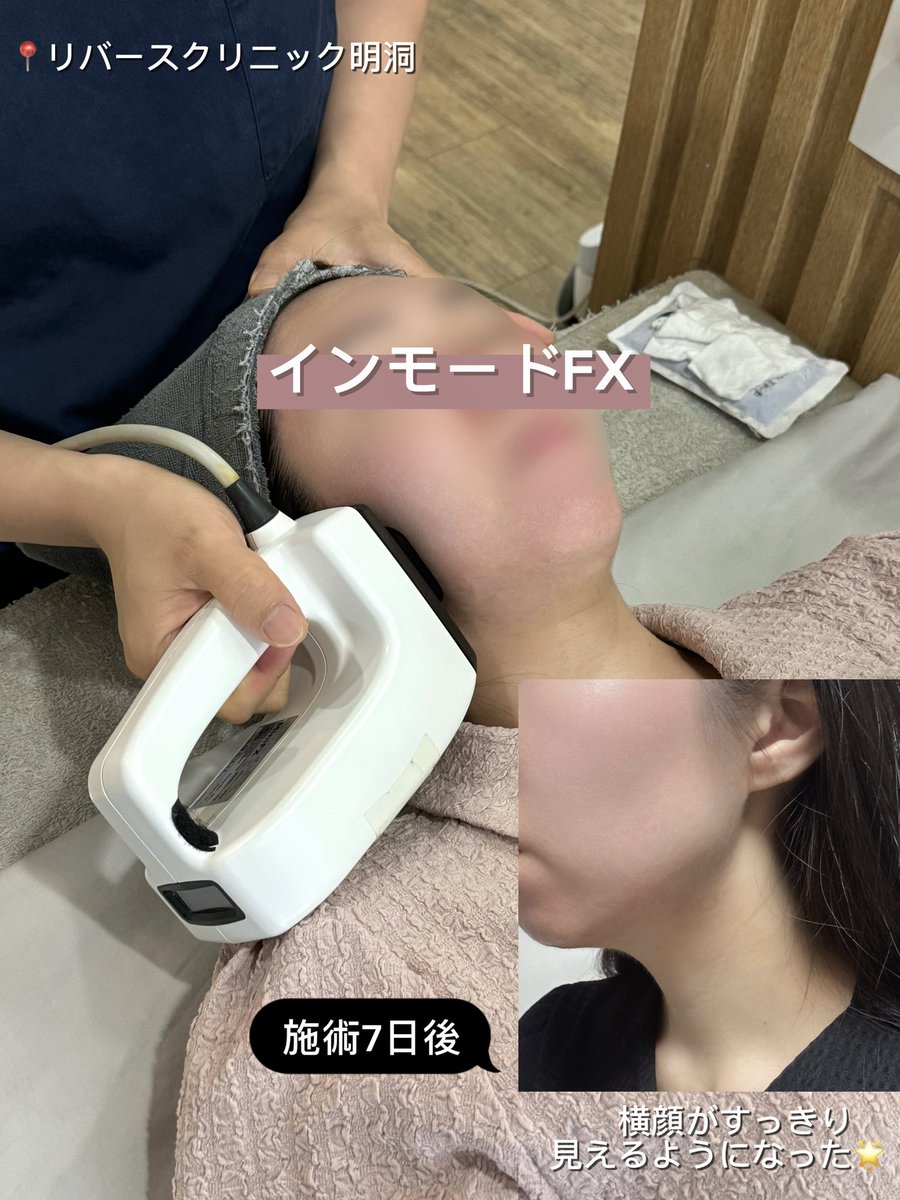 tripmaster_mzn's tweet photo. 【#リバースクリニック 明洞店】でインモードFXを施術していただきました🏥
個人的には施術中は吸引されている感覚で痛みはほとんどなし✨ダウンタイムも赤みが少し出た程度でメイクでも隠せました😊施術中も声をかけてくださり安心して受けられました🫶🏻
#インモードFX #韓国美容クリニック #韓国旅行 https://t.co/wCuTasykRQ