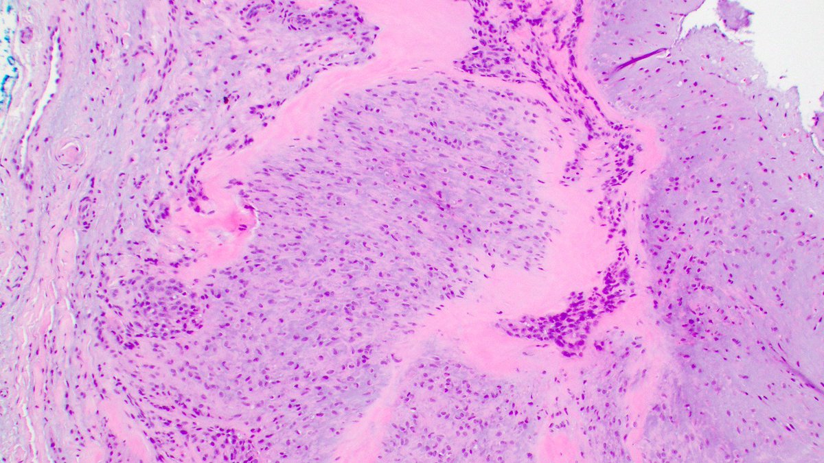 MirunaPopescu13's tweet photo. Happy and honored to see our @Pathoutlines article on Acral Fibrochondromyxoid Tumor published online! 

👉🏻https://t.co/j8e4gCn1x4

Here's three things to remember about this benign tumor:
▶️Well circumscribed w/ lobules separated by fibrous septa with numerous slit-like blood vessels & hyalinization at the septal periphery
▶️Cells look myoepithelial-like in a fibrochondromyxoid stroma, but are panCK & SOX10/S100 negative!
▶️Partial cartilaginous differentiation: consistently CD34+, ERG+ (and in 70% of cases also SOX9).
💎Bonus: it harbors a recurrent THBS1::ADGRF5 fusion.

Check out the full PathOut article using the link above! 

#BSTPath #PathTwitter