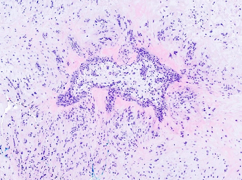 MirunaPopescu13's tweet photo. Happy and honored to see our @Pathoutlines article on Acral Fibrochondromyxoid Tumor published online! 

👉🏻https://t.co/j8e4gCn1x4

Here's three things to remember about this benign tumor:
▶️Well circumscribed w/ lobules separated by fibrous septa with numerous slit-like blood vessels & hyalinization at the septal periphery
▶️Cells look myoepithelial-like in a fibrochondromyxoid stroma, but are panCK & SOX10/S100 negative!
▶️Partial cartilaginous differentiation: consistently CD34+, ERG+ (and in 70% of cases also SOX9).
💎Bonus: it harbors a recurrent THBS1::ADGRF5 fusion.

Check out the full PathOut article using the link above! 

#BSTPath #PathTwitter