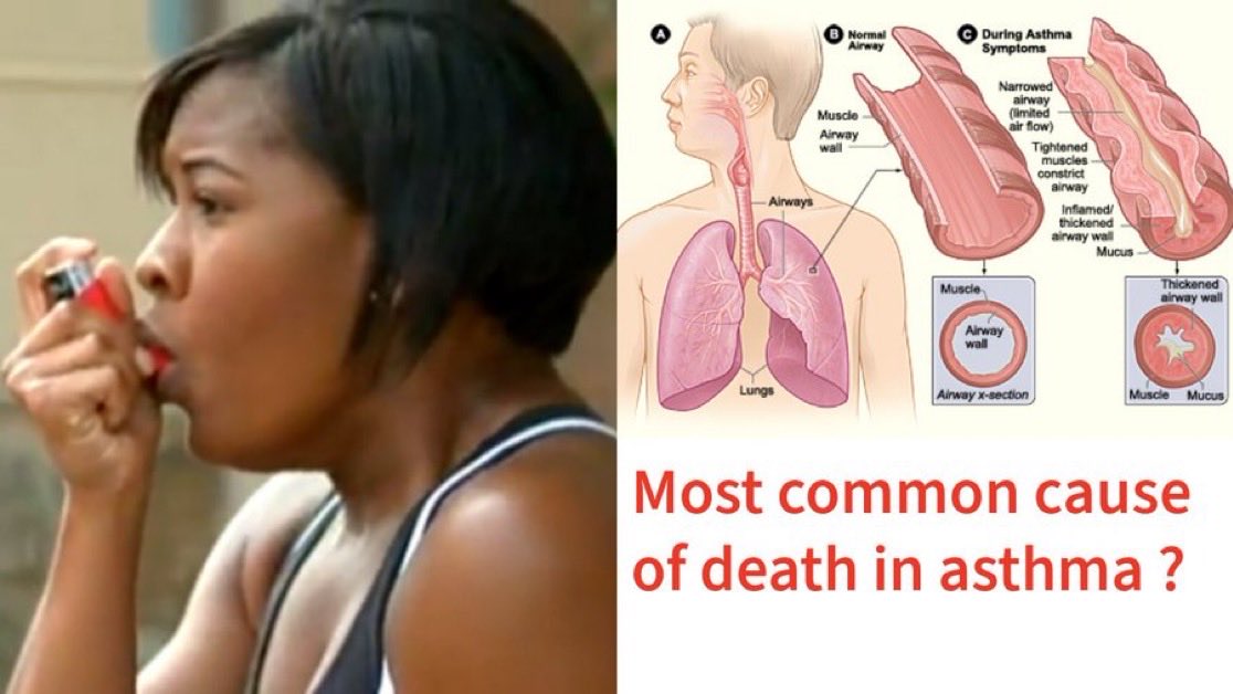 MedLearnHub's tweet photo. Q. What is the Most common cause of death in asthma ?

a. Mucus plugging.
b. Pneumonia.
c. Respiratory failure.
d. Cardiac arrest. https://t.co/reUEg45vjO
