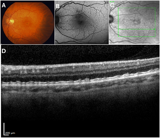 ARVOiovs's tweet photo. SriniVas R. Sadda et al from Doheny Eye Institute assess the impact of subretinal drusenoid deposits (SDDs) on EZ-based quantitative metrics in nonneovascular age-related macular degeneration (AMD).
https://t.co/skmh2Yze0d https://t.co/KuoXdT6uRQ