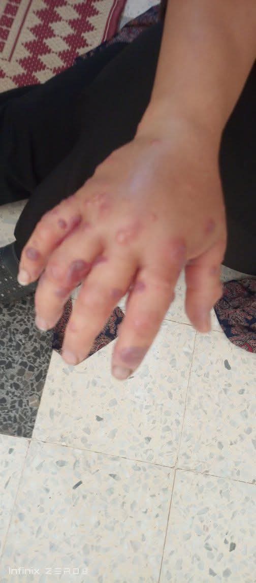 yousefQasem1998's tweet photo. In Gaza, even the mosquito has become part of the daily suffering.
Heat, tents, stagnant water, and harsh conditions make everything harder — even sleep is no longer peaceful.
Yet people are still trying to survive through it all. 😭 https://t.co/a3oNiQ3yoL