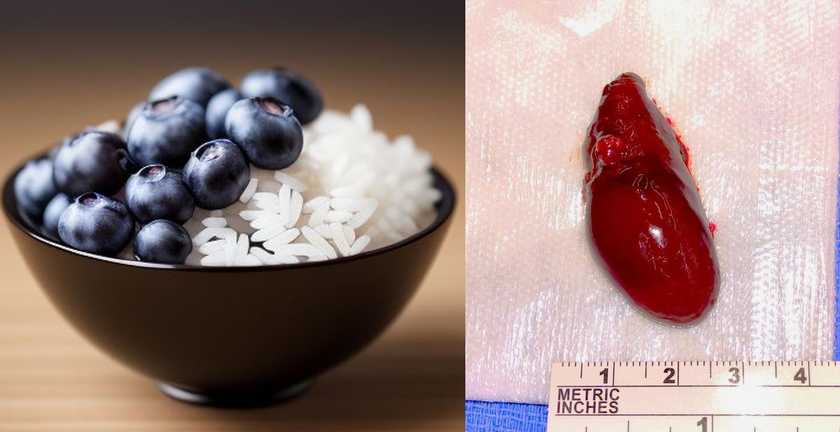 TheAAES's tweet photo. July is Parathyroid Awareness Month (#PAM)! Normal parathyroid glands are tiny – like a grain of rice. A parathyroid adenoma can be the size of a large blueberry or even a grape! #CheckYourCalcium #PAM2026 @AACE @Paratroupers https://t.co/F4OOARBPxa