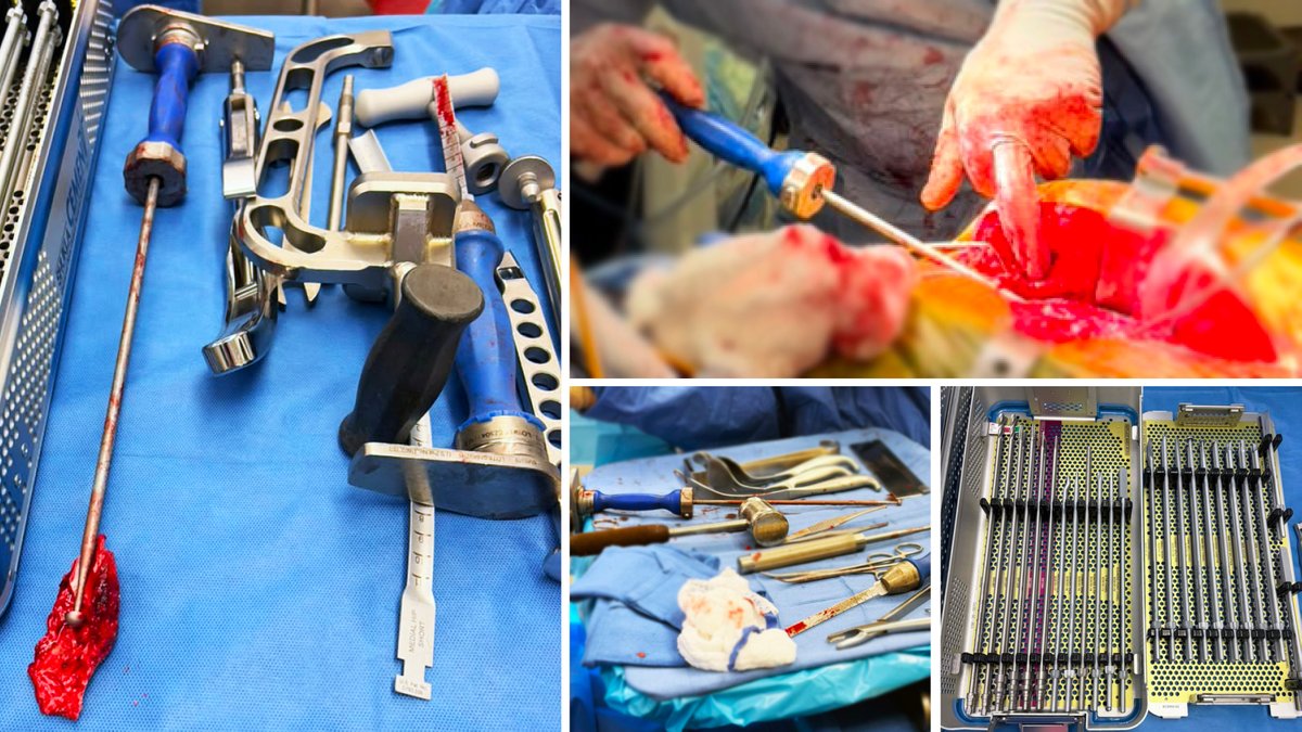 ShuklaMedical's tweet photo. The new SHUKLA Cement system is already saving time in the OR and driving new #ShuklaSuccessStory moments. Removing bone cement sucks, there are no two ways about it. But with #ShuklaMedical in the room, the time spent removing it becomes drastically reduced.
#orthopedicsurgery https://t.co/S8qRsig7M8