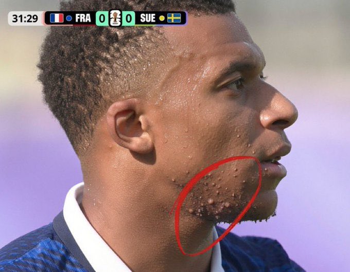 beast8pk's tweet photo. Hey @grok What's this thing on Mbappé's skin?? https://t.co/ucu5LaTMH9